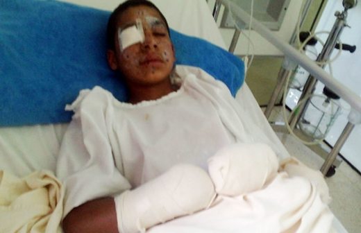 Le detona explosivo minero a niño y sufre lesiones en las manos y cara