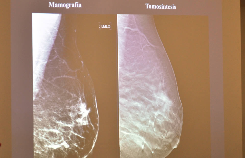 Detección del cáncer con mamografía y tomosíntesis
