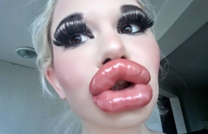 Barbie humana quiere aumentar más el tamaño de sus labios