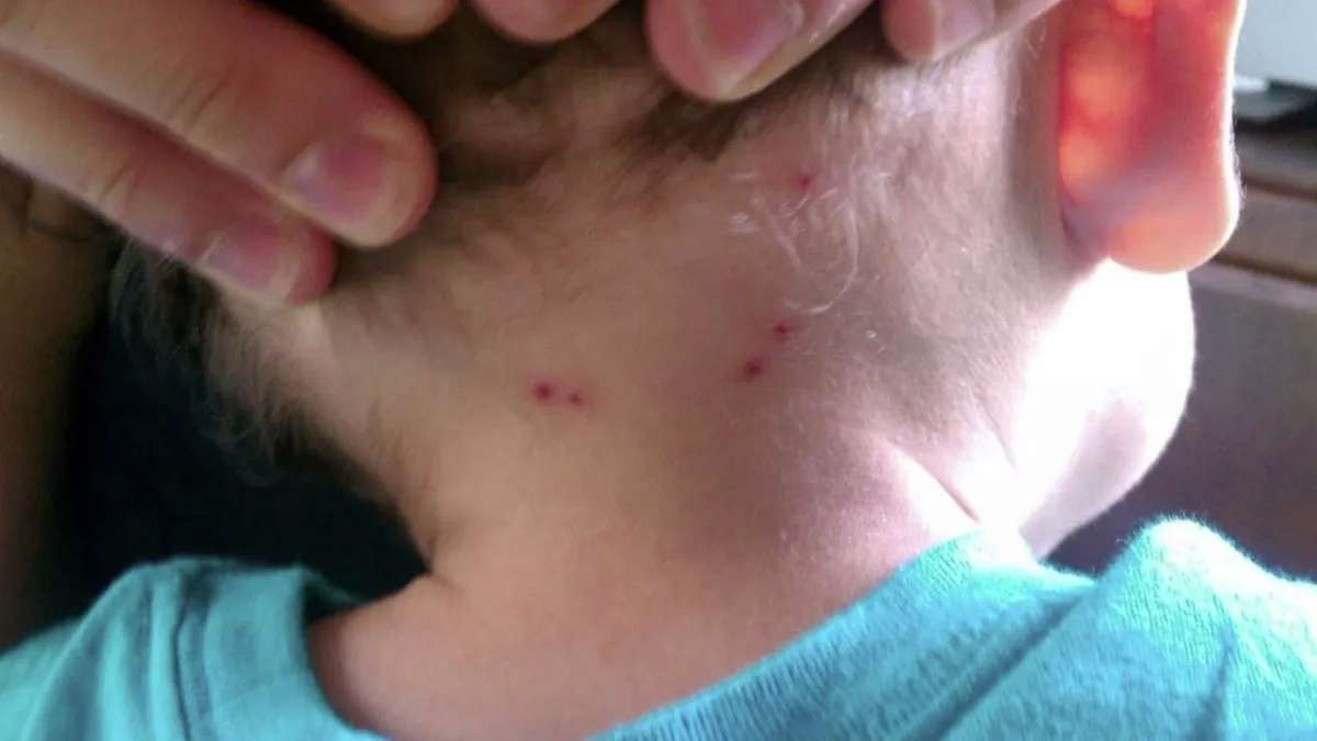 Suman 51 casos de rickettsia y 21 muertos en el estado