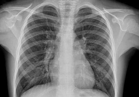 Van más de 6 mil casos de neumonía y bronconeumonía en lo que va del año