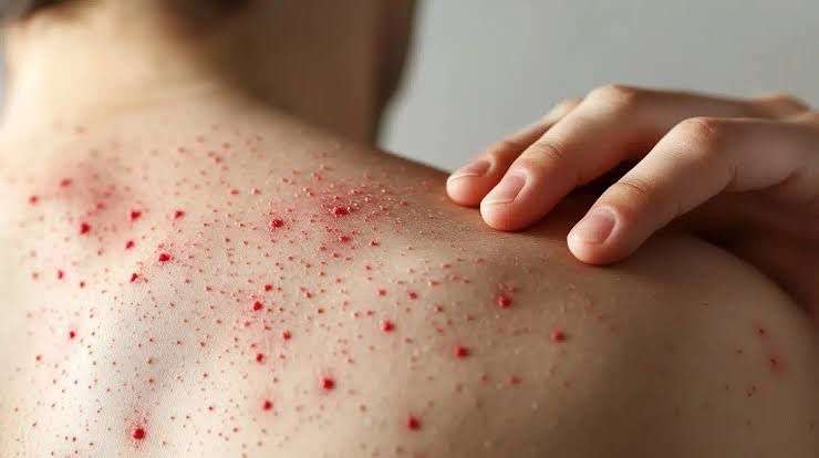 Aumentan casos de sarampión en Chihuahua