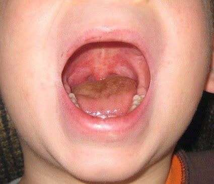 Registran 63 brotes de Coxsackie en 11 municipios