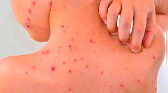 Ascienden a 45 las muertes por rickettsiosis en el estado