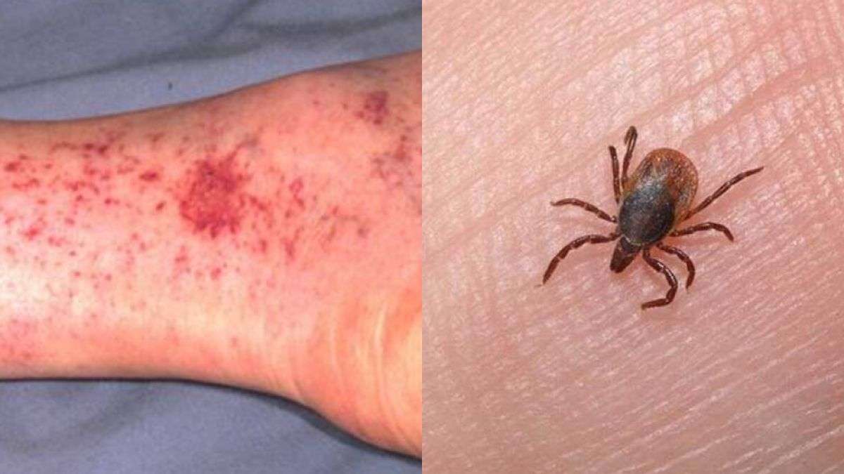 Deja Rickettsia 45 muertes y 95 casos confirmados en Chohuahua