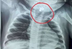 Descubren anillo atorado en la garganta de una bebé