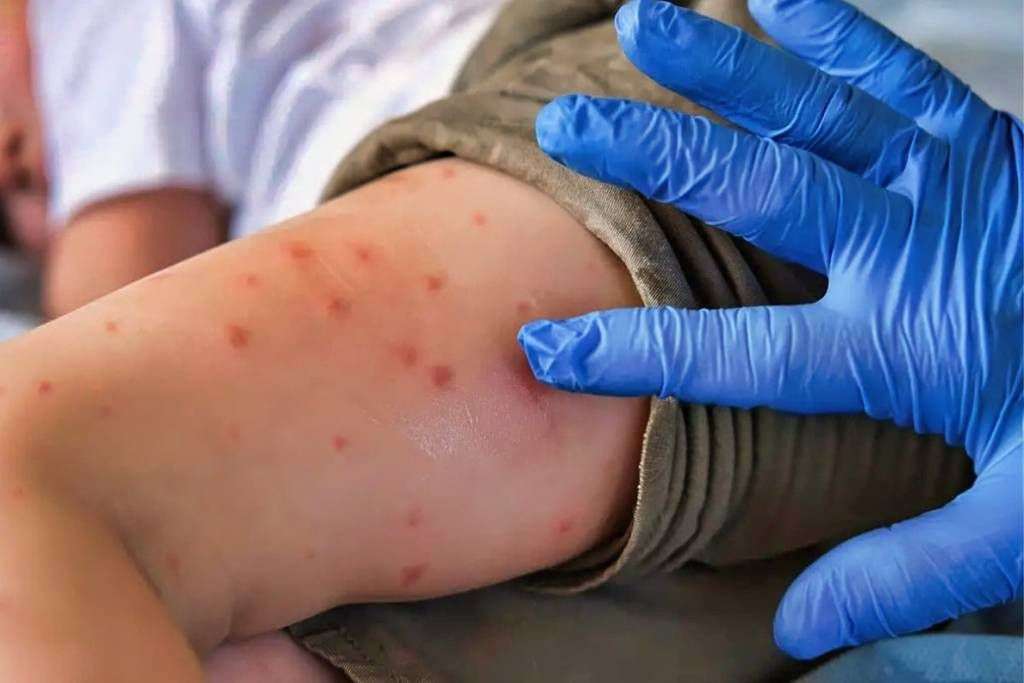 Deja sarampión en Chihuahua miles de contagios