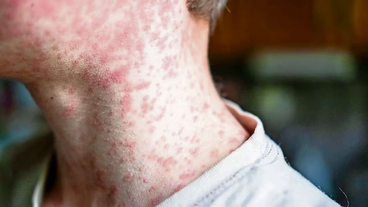 Suman 28 muertes por sarampión en el país