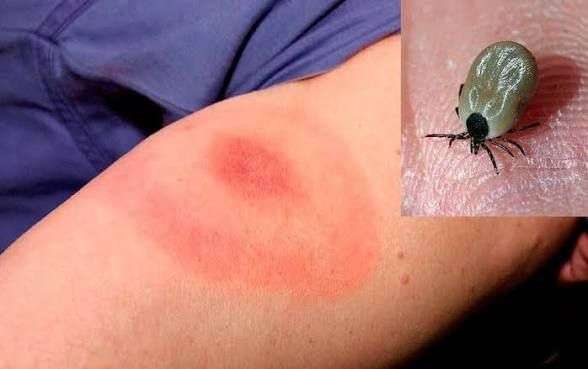 Aumentan casos de enfermedad por garrapatas 