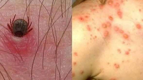 Reportan nuevo caso de rickettsiosis en una niña