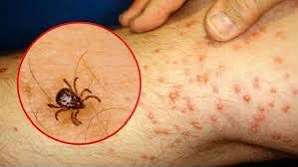Golpea Rickettsiosis van 33 muertes 