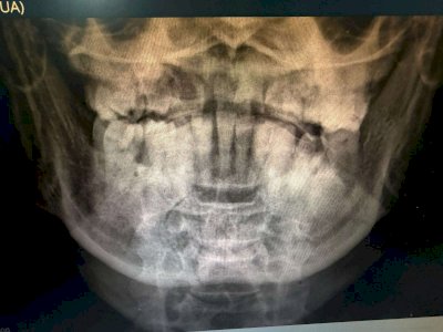Denuncian falta de insumos para cirugía en el Central