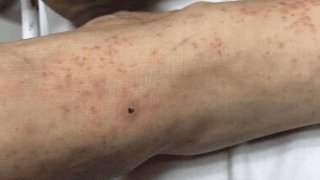 Aumentan a 129 casos y 58 defunciones por rickettsiosis