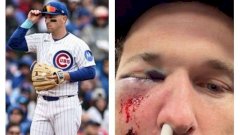 Sufre impactante pelotazo en la cara pelotero de Cachorros