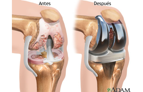 Cubre el Seguro Popular la artroplastia de rodilla