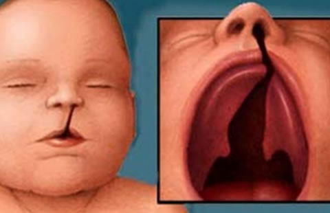 Exposición a agentes químicos, drogas, alcohol y tabaco pueden causar paladar hendido al feto