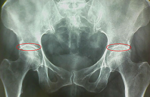 Es coxartrosis enfermedad que disminuye dureza y resistencia de las caderas
