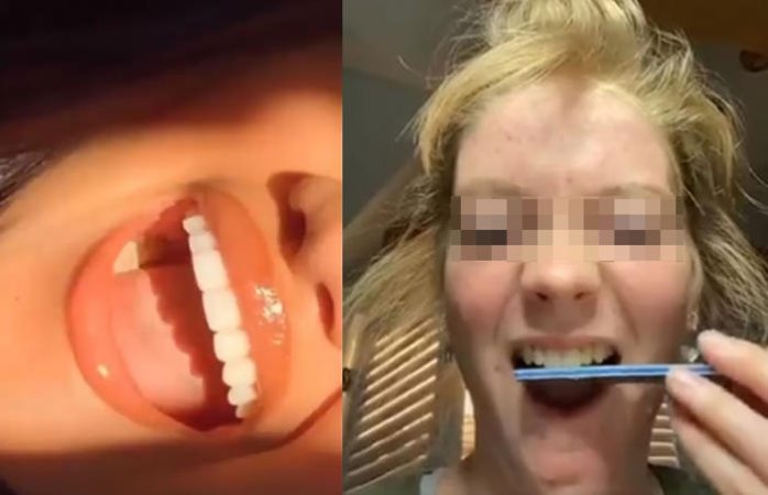 Alertan a padres por reto de limarse los dientes 